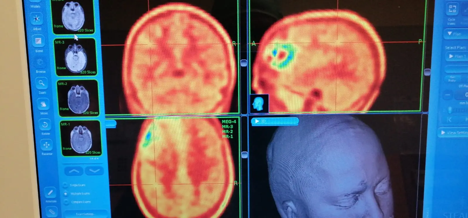 scopri come chatgpt sta rivoluzionando la radiologia nella diagnosi dei tumori cerebrali. esplora le tecnologie avanzate che migliorano l'accuratezza e la velocità delle diagnosi, offrendo nuove speranze ai pazienti.